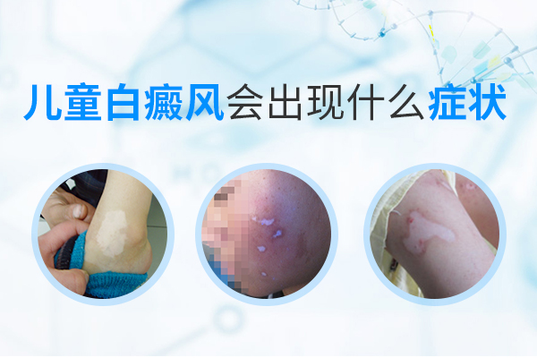 幼儿早期白癜风有什么症状？